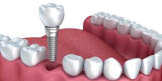 IMPLANT DENTAR